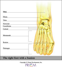right foot with bunion