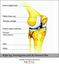 Knee Joint with fracture