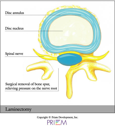 Laminectomy