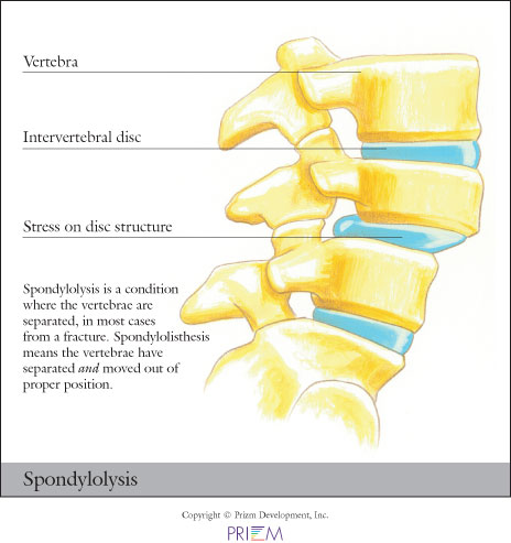 spondylolysis