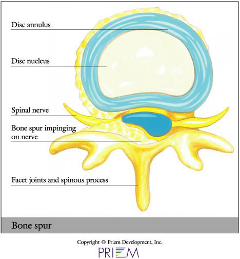 University Orthopedics - Bone Spur