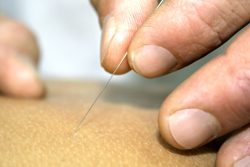 acupuncture